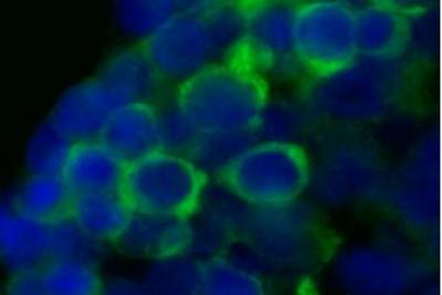 Scoperta italiana choc: "Dna 'alieno' in un malato di leucemia acuta su 2"