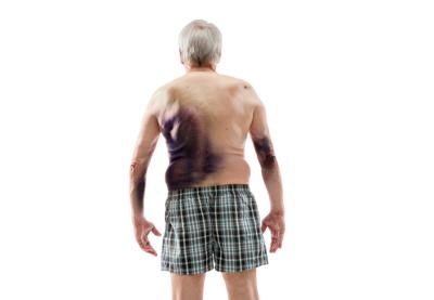 Emofilici, solo un quarto &egrave; informato sulle cure