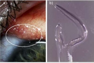 Le brucia un occhio, dentro ci sono 14 vermi