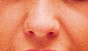 Malattie respiratorie in aumento