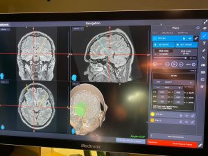 Avviata la rete interaziendale tra la Asl di Viterbo e Roma 4 per la gestione integrata dei pazienti con tumore cerebrale
