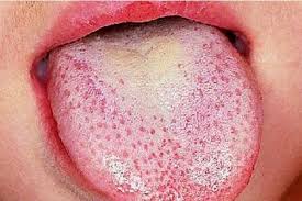 Anche nella Tuscia è allarme streptococco: si moltiplicano i casi e scarseggiano i medicinali