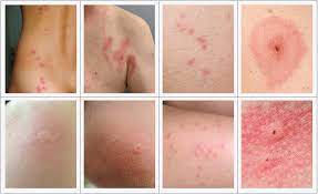 Punture da insetto, alla Asl di Rieti è possibile prenotare una prima visita visita in caso di reazioni allergiche