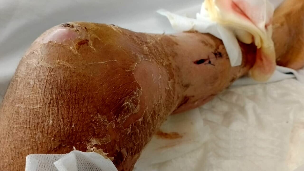 Rieti – Virus mangiacarne, 49enne in fin di vita dopo una caduta sul Terminillo