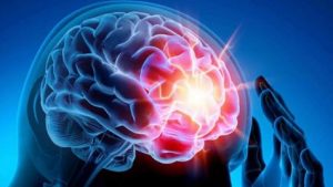 EPILESSIA SONO: COMORBODITÀ FREQUENTE IN PAZIENTI AFFETTI DA TUMORI CEREBRALI
