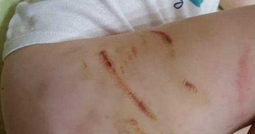 Indagato il padrone di Atos: il pitbull ha morso per omessa custodia