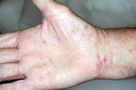 Scabbia al liceo classico Mariano Buratti di Viterbo: allarme tra le famiglie