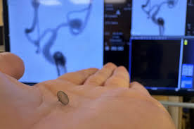 Trattamento aneurismi cerebrali con stampa 3d e realtà aumentata: Belcolle tra i primi in Italia