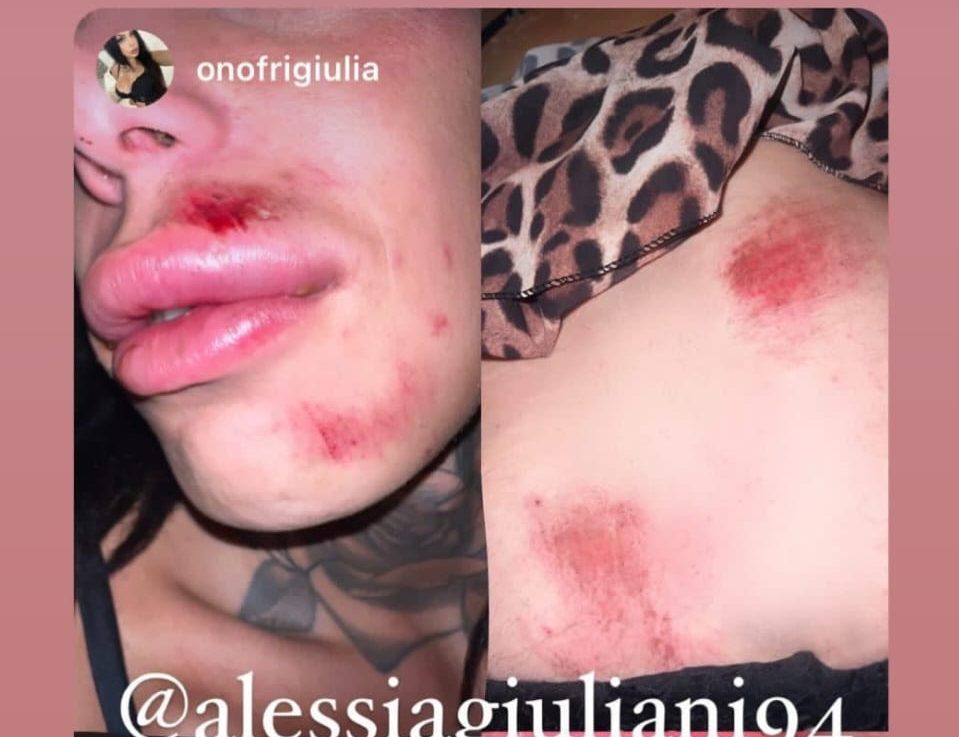 Castiglione in Teverina – Aggressione verso trans si trasforma in rissa