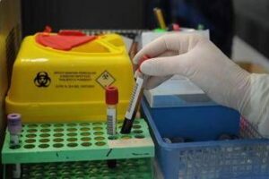 Alzheimer, via libera a test del sangue per diagnosi: cosa significa