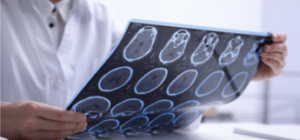 Sclerosi multipla per 144mila italiani, 10% è fuori da percorsi cura e assistenza