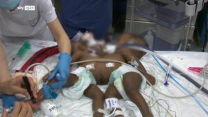 Sorelline siamesi separate dopo intervento di 12 ore