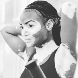 Giornata della vitiligine contro stigma e falsi miti, un ‘doppio attacco’ può batterla