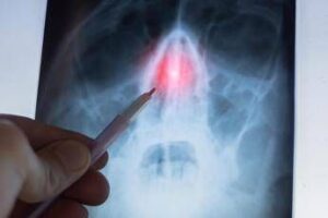 Rinosinusite cronica con poliposi nasale, l’otorino: “Con biologici verso remissione”