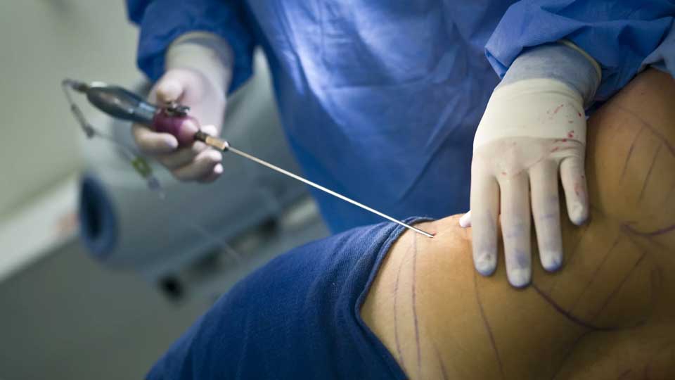 Roma – Donna muore dopo un intervento di liposuzione, il titolare del centro operava senza autorizzazione
