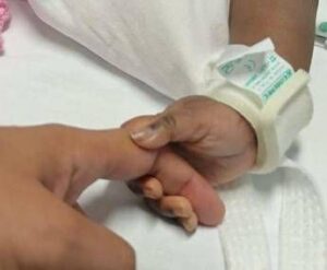 Gemelle siamesi separate al Gaslini di Genova: “Estubate, respirano da sole”