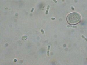 Batterio mangiacarne uccide 4 persone, Bassetti: “Colpa del clima”