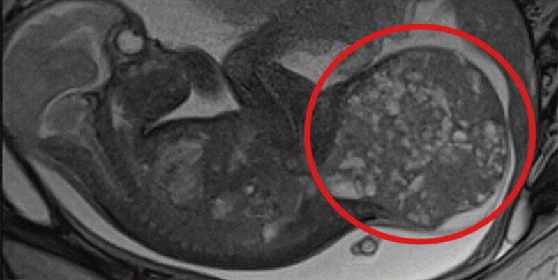 Roma – Bimba con tumore di 800 grammi: salvata grazie a un doppio intervento prima e dopo la nascita