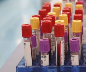 Botulino, dal 2001 al 2024 segnalati 1.276 casi in Italia