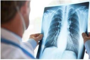 Curare il cancro al polmone senza chirurgia, prima italiana all’Ieo di Milano