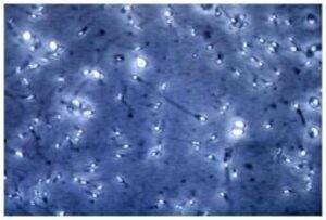 Microplastiche nella prostata e nel liquido seminale, la scoperta italiana: cosa comporta