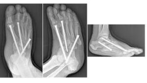 Piede di Charcot, al Gemelli soluzioni avanzate per una complicanza rara del diabete