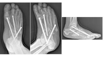 Piede di Charcot, al Gemelli soluzioni avanzate per una complicanza rara del diabete