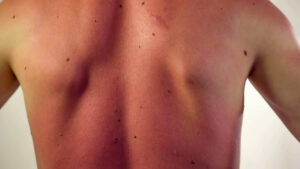 Tumori cutanei non melanoma, ecco cosa sono. E occhio all’esposizione al sole