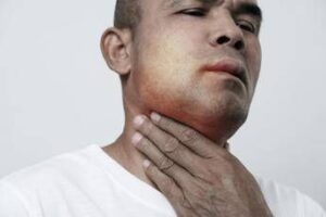 Angioedema ereditario, Aifa estende uso lanadelumab dai 2 anni di età