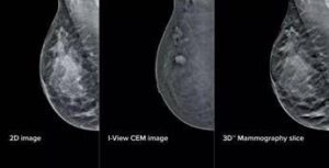 Mammografia ‘intelligente’ al San Camillo di Roma, aiuterà gli specialisti nelle diagnosi