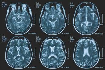 Tumori, glioma pediatrico di basso grado: via libera in Europa a prima terapia mirata