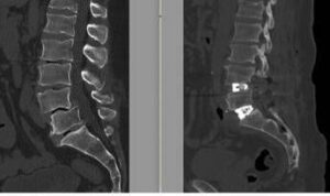 Chirurgia vertebrale complessa, al Tiberia Hospital di Roma intervento con tecnica Alif