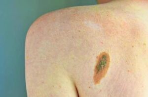 Melanoma, Adoi: “Bene nuova legge su prevenzione, dermatologo centrale in screening”