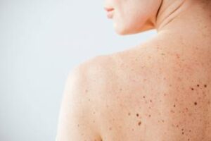 Nei e sole, Sidemast lancia la Giornata della prevenzione dermatologica