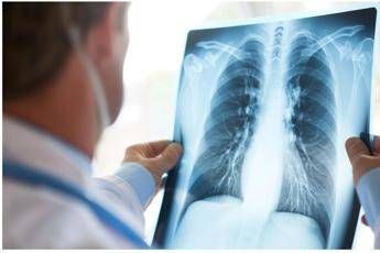 Cancro polmone Egfr-mutato, studio fase 3 Adaura: “Il 79% dei pazienti vivo a 8 anni con Osimertinib”