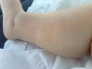 Dermatite Atopica, la storia di Federica