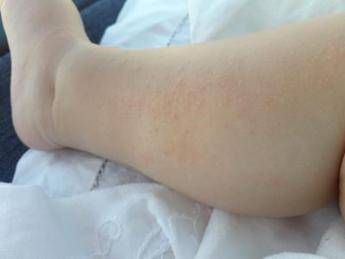 Dermatite Atopica, la storia di Federica