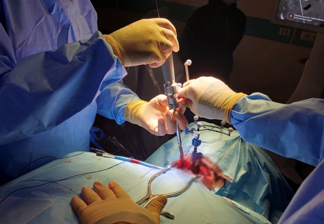 Sanità, al San Filippo Neri di Roma il primo intervento cervicale in Italia con la neuronavigazione 3D